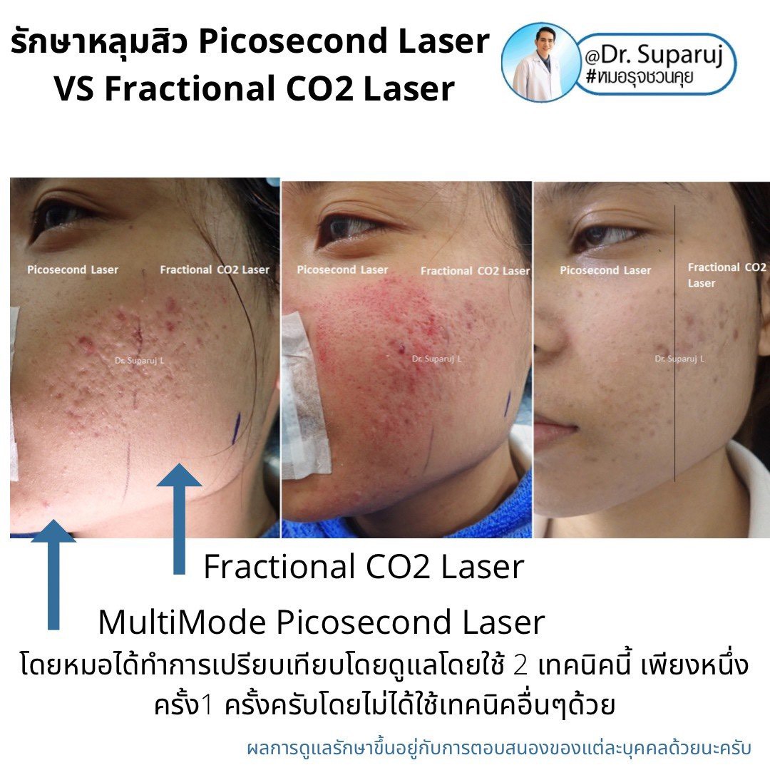 เจาะลึกความแตกต่าง: Fractional CO2 vs Fractional Picosecond Laser ในการรักษาหลุมสิว