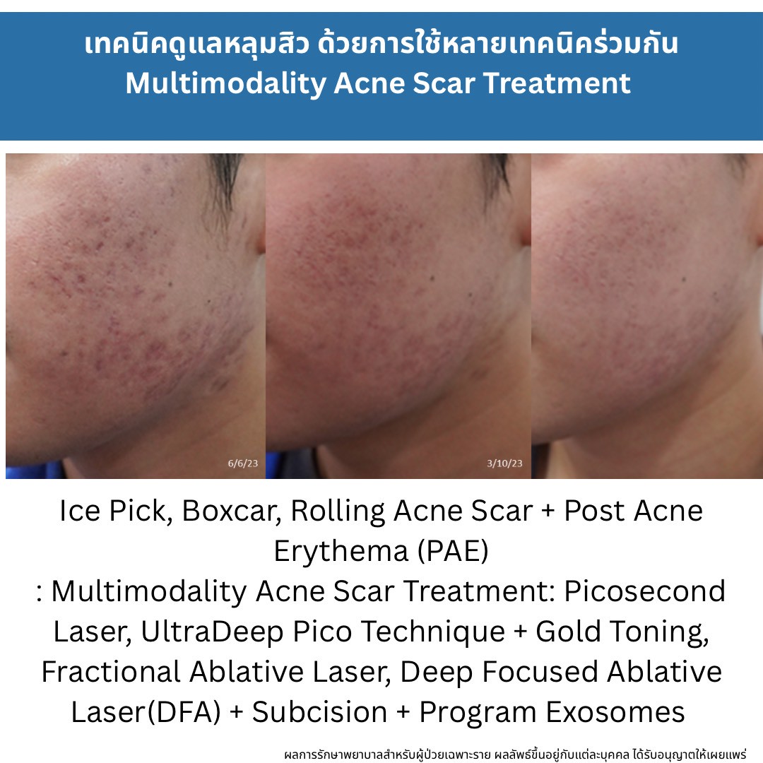 รักษาหลุมสิวแต่พักหน้าไม่ได้ มีวิธีอะไรบ้าง ? How to Treat Acne Scars When You Can’t Afford a Recovery Period แนวทางการรักษาหลุมสิวสำหรับผู้ที่ไม่สามารถพักหน้าได้ (Social Down-time Limited)ครับ.