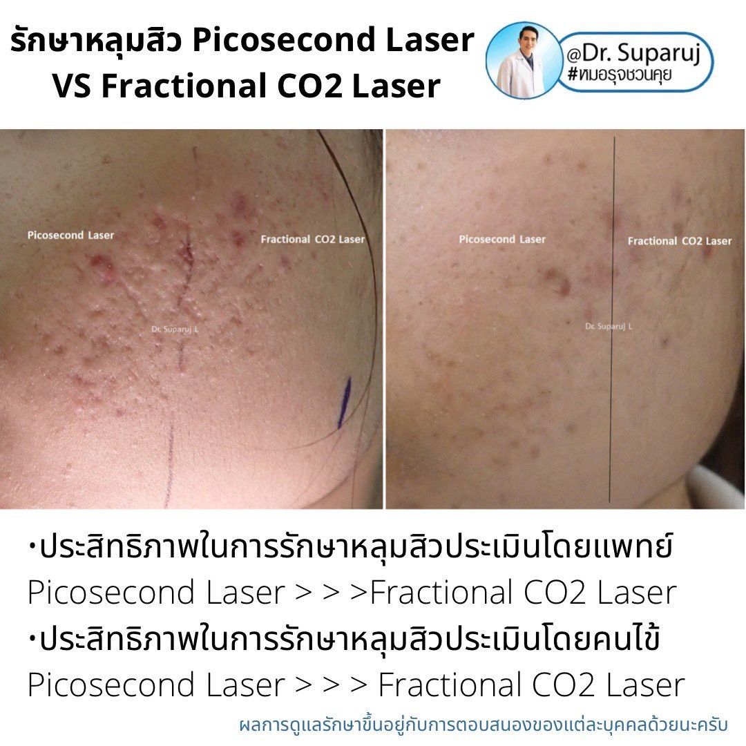 เจาะลึกความแตกต่าง: Fractional CO2 vs Fractional Picosecond Laser ในการรักษาหลุมสิว