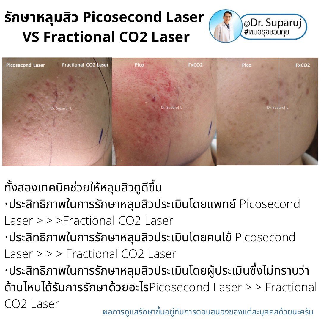 เจาะลึกความแตกต่าง: Fractional CO2 vs Fractional Picosecond Laser ในการรักษาหลุมสิว เจาะลึกความแตกต่าง: Fractional CO2 vs Fractional Picosecond Laser ในการรักษาหลุมสิว