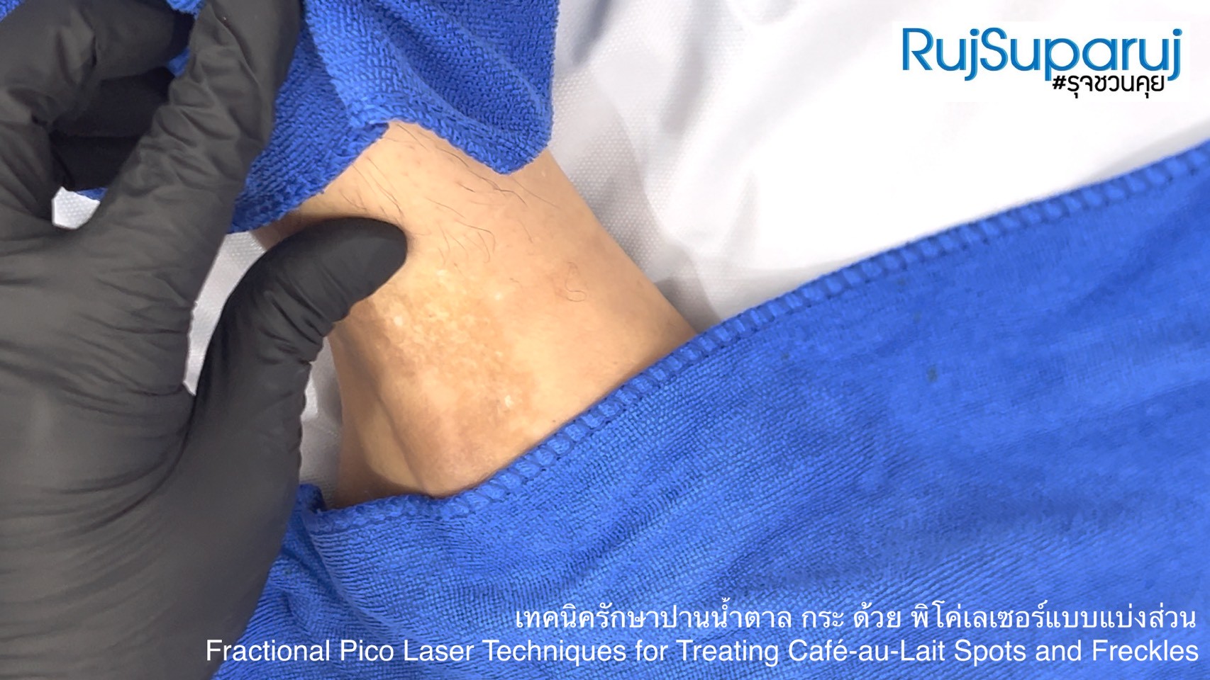 เทคนิครักษาปานน้ำตาล กระ ด้วย พิโค่เลเซอร์แบบแบ่งส่วน Fractional Pico Laser Techniques for Treating Café-au-Lait Spots and Freckles เทคนิครักษาปานน้ำตาล กระ ด้วย พิโค่เลเซอร์แบบแบ่งส่วน Fractional Pico Laser Techniques for Treating Café-au-Lait Spots and Freckles