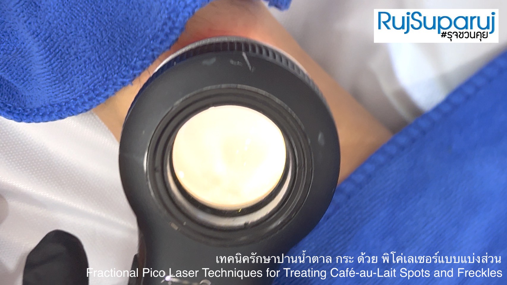 เทคนิครักษาปานน้ำตาล กระ ด้วย พิโค่เลเซอร์แบบแบ่งส่วน Fractional Pico Laser Techniques for Treating Café-au-Lait Spots and Freckles เทคนิครักษาปานน้ำตาล กระ ด้วย พิโค่เลเซอร์แบบแบ่งส่วน Fractional Pico Laser Techniques for Treating Café-au-Lait Spots and Freckles