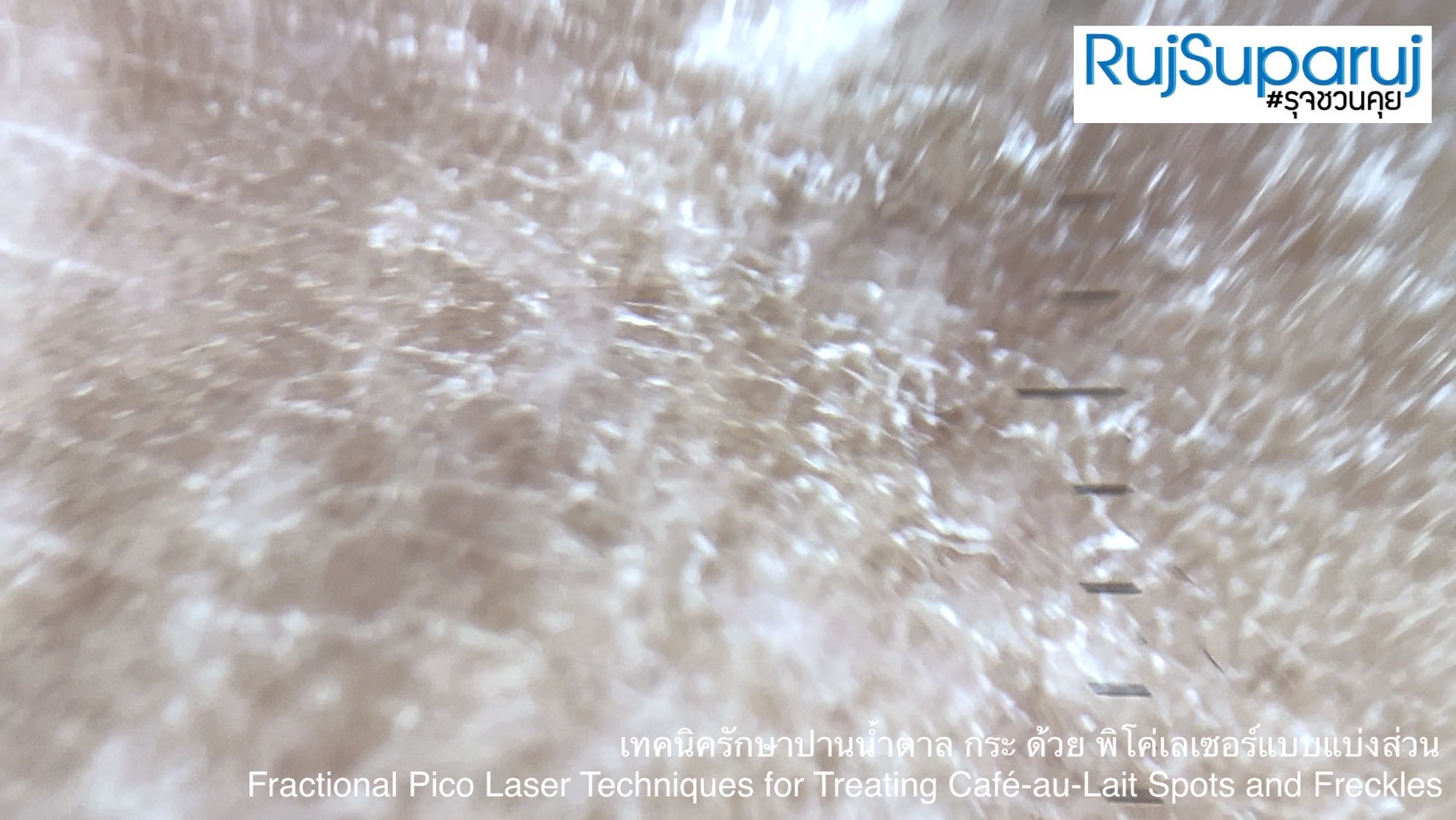 เทคนิครักษาปานน้ำตาล กระ ด้วย พิโค่เลเซอร์แบบแบ่งส่วน Fractional Pico Laser Techniques for Treating Café-au-Lait Spots and Freckles