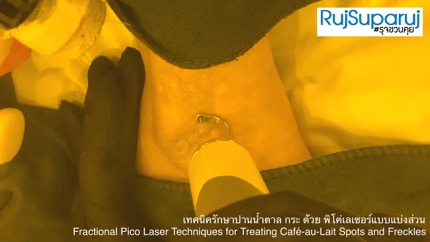 เทคนิครักษาปานน้ำตาล กระ ด้วย พิโค่เลเซอร์แบบแบ่งส่วน Fractional Pico Laser Techniques for Treating Café-au-Lait Spots and Freckles เทคนิครักษาปานน้ำตาล กระ ด้วย พิโค่เลเซอร์แบบแบ่งส่วน Fractional Pico Laser Techniques for Treating Café-au-Lait Spots and Freckles