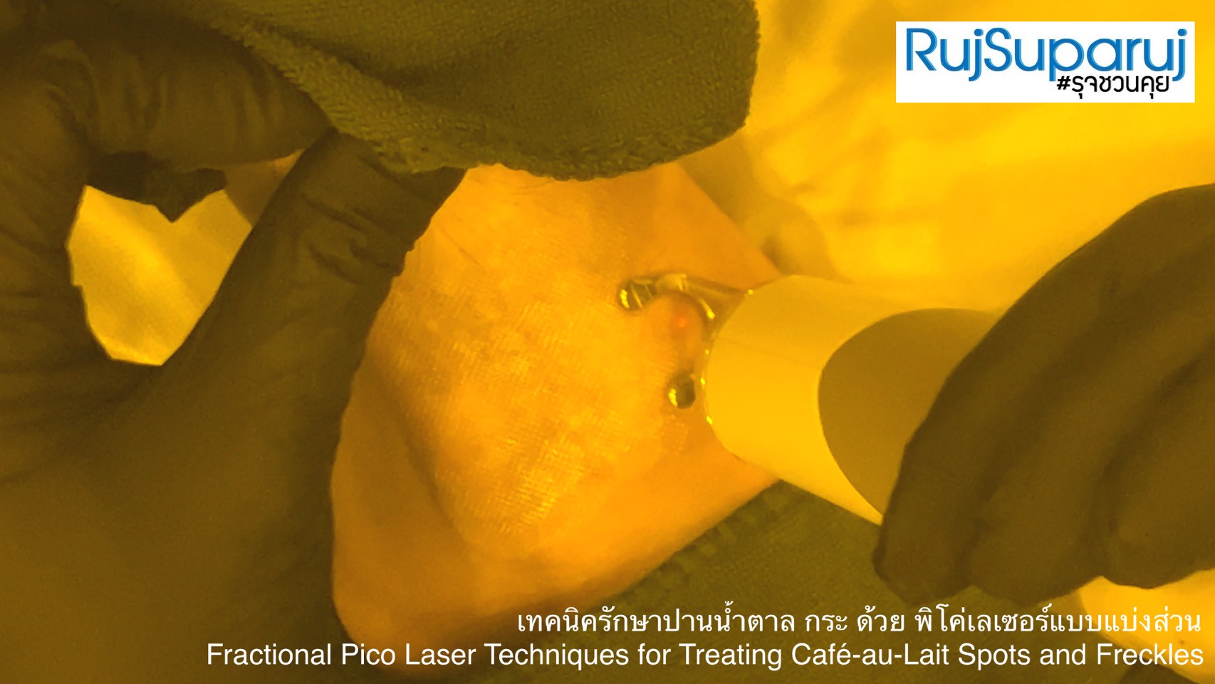เทคนิครักษาปานน้ำตาล กระ ด้วย พิโค่เลเซอร์แบบแบ่งส่วน Fractional Pico Laser Techniques for Treating Café-au-Lait Spots and Freckles เทคนิครักษาปานน้ำตาล กระ ด้วย พิโค่เลเซอร์แบบแบ่งส่วน Fractional Pico Laser Techniques for Treating Café-au-Lait Spots and Freckles
