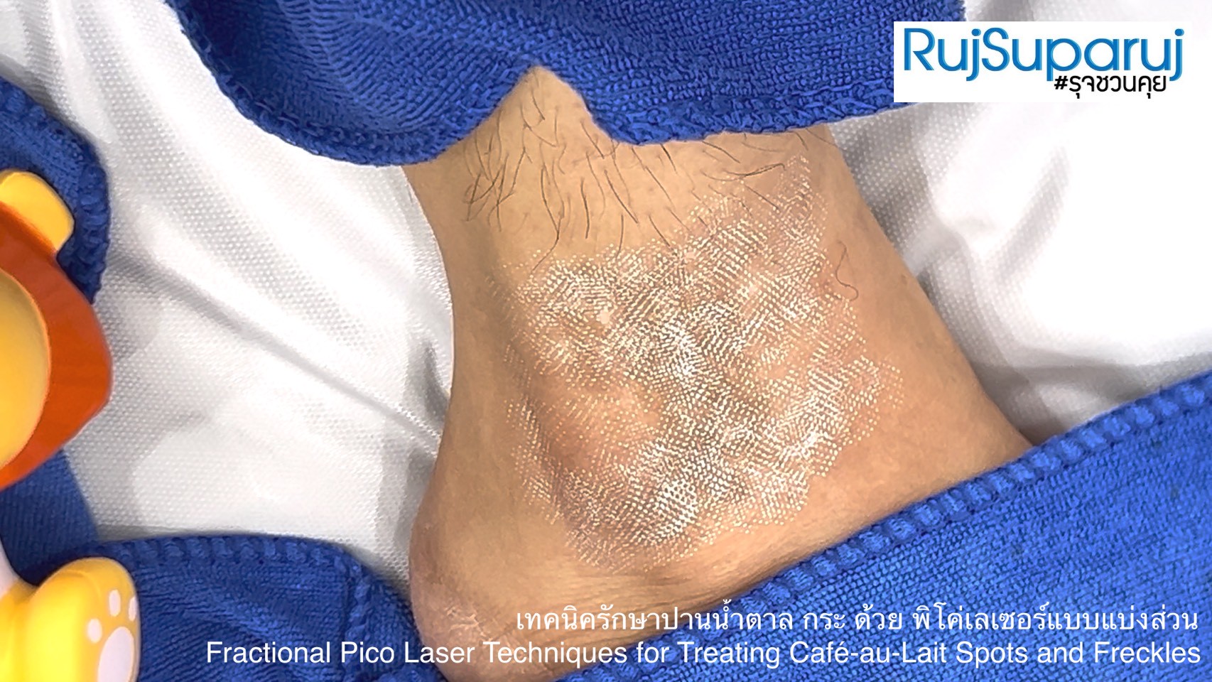 เทคนิครักษาปานน้ำตาล กระ ด้วย พิโค่เลเซอร์แบบแบ่งส่วน Fractional Pico Laser Techniques for Treating Café-au-Lait Spots and Freckles เทคนิครักษาปานน้ำตาล กระ ด้วย พิโค่เลเซอร์แบบแบ่งส่วน Fractional Pico Laser Techniques for Treating Café-au-Lait Spots and Freckles