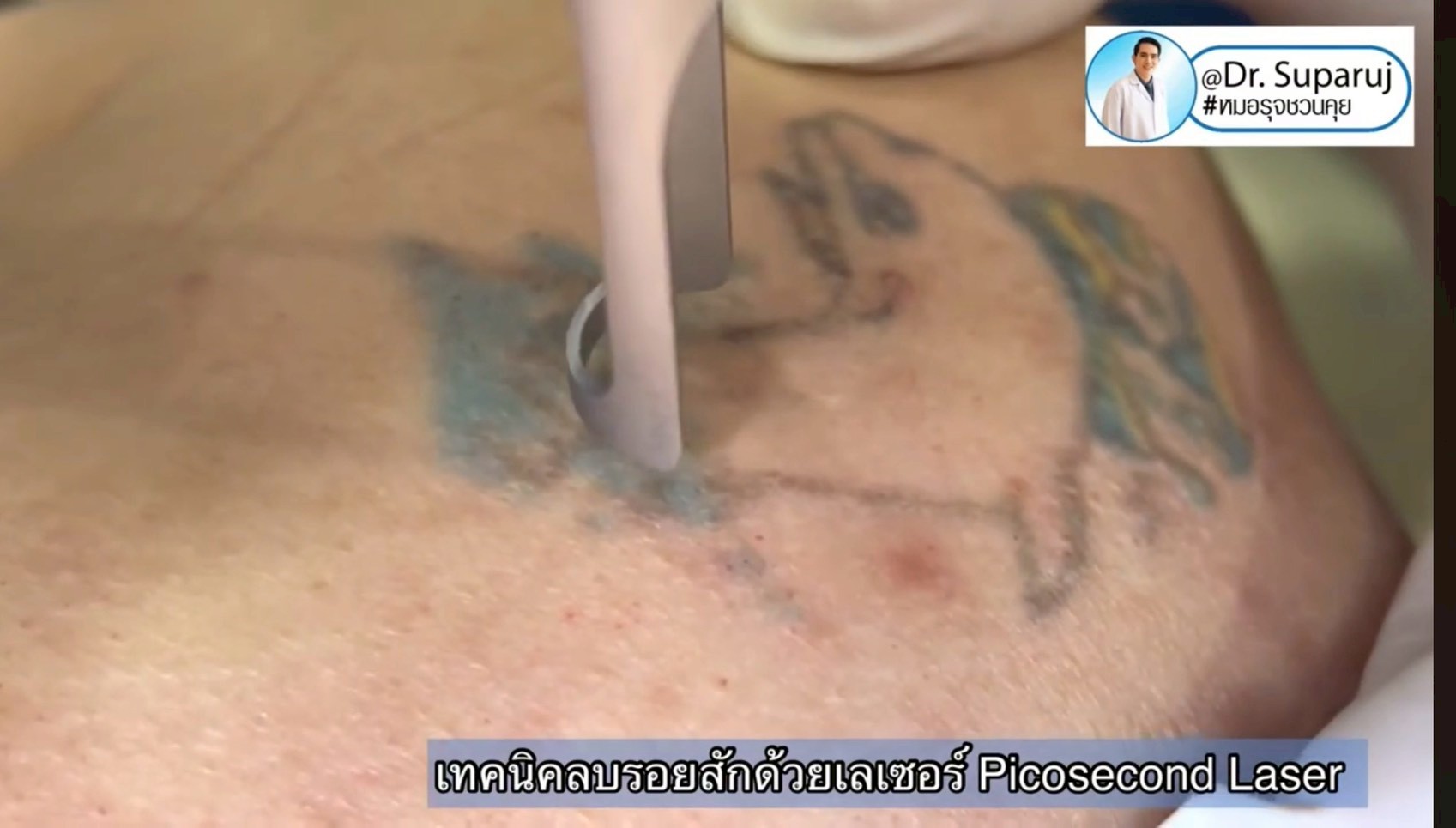 เทคนิคลบรอยสักด้วยเลเซอร์ Picosecond Laser
