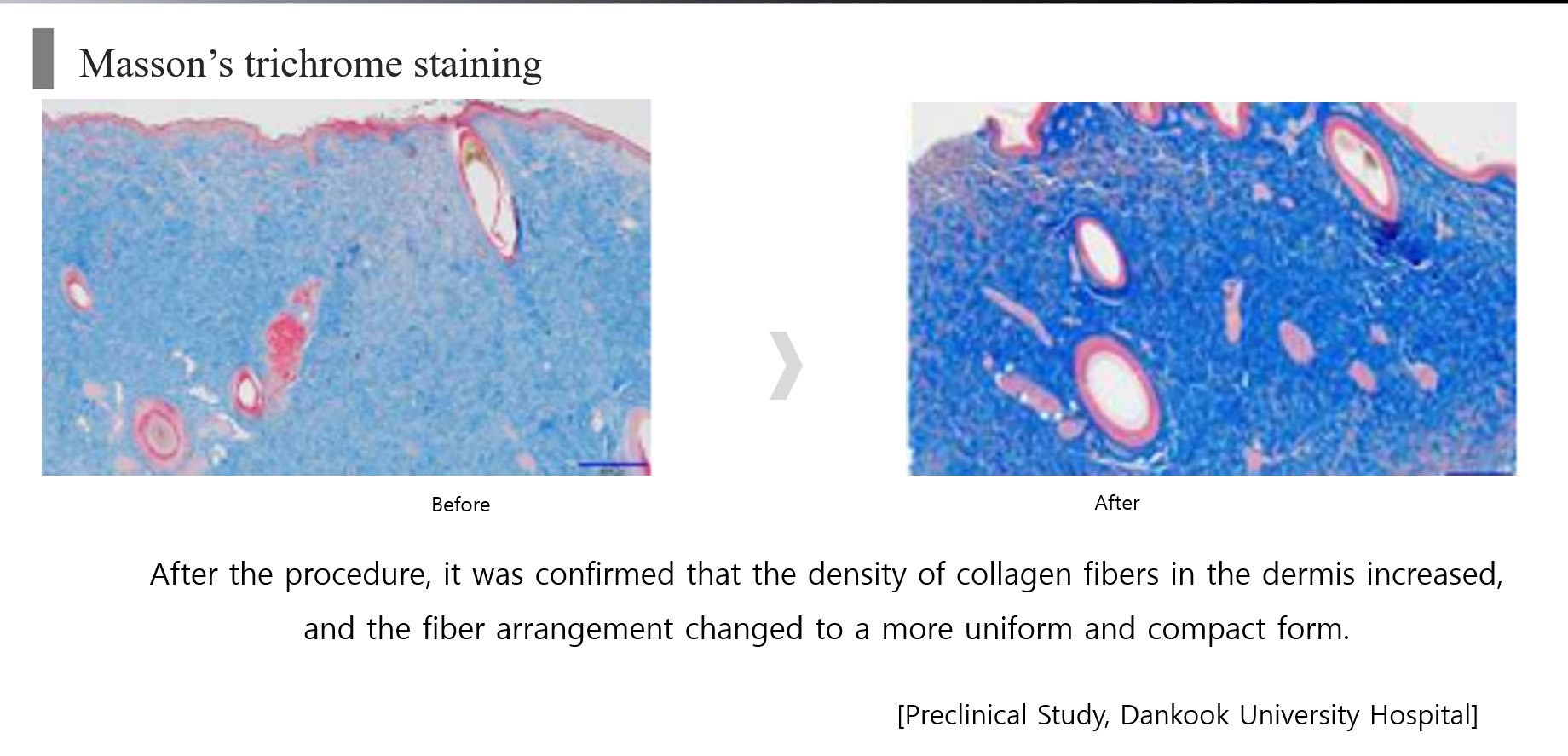 เทคนิค ยกกระชับใบหน้าและคิ้วด้วย เทคนิค Triple-Lined Multifocused Ultrasound