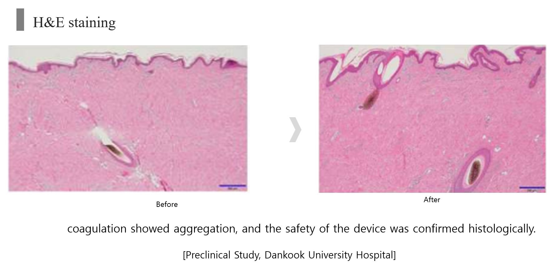 เทคนิค ยกกระชับใบหน้าและคิ้วด้วย เทคนิค Triple-Lined Multifocused Ultrasound