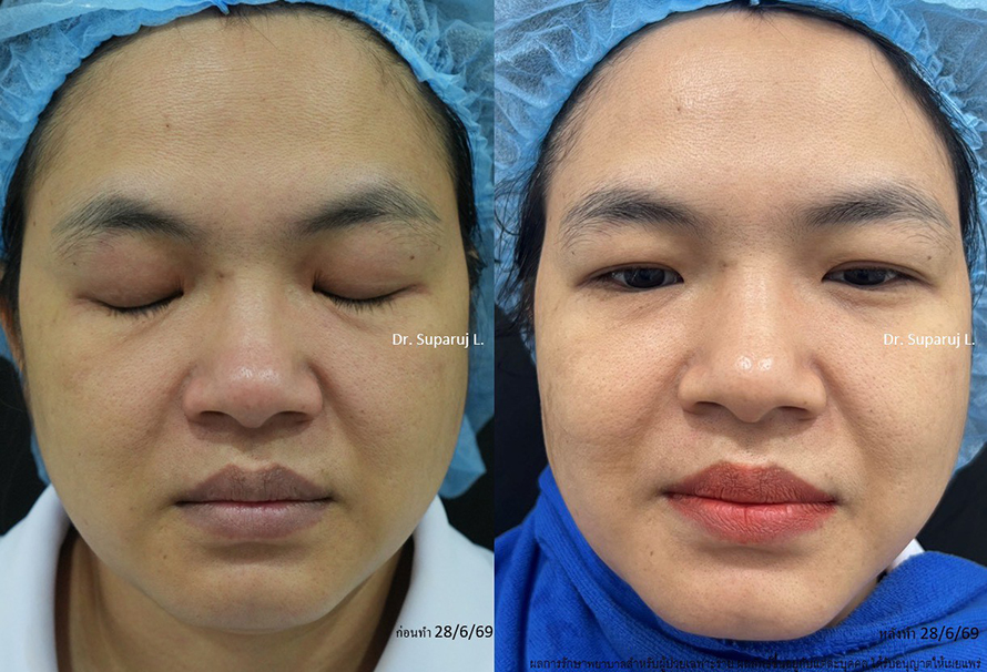แนะนำโปรแกรมยกกระชับผิวด้วยเลเซอร์ หลายความยาวคลื่น Program Platinum Lifting Multi-Wavelength Laser