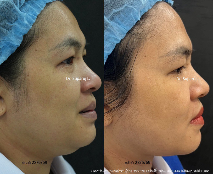 แนะนำโปรแกรมยกกระชับผิวด้วยเลเซอร์ หลายความยาวคลื่น Program Platinum Lifting Multi-Wavelength Laser