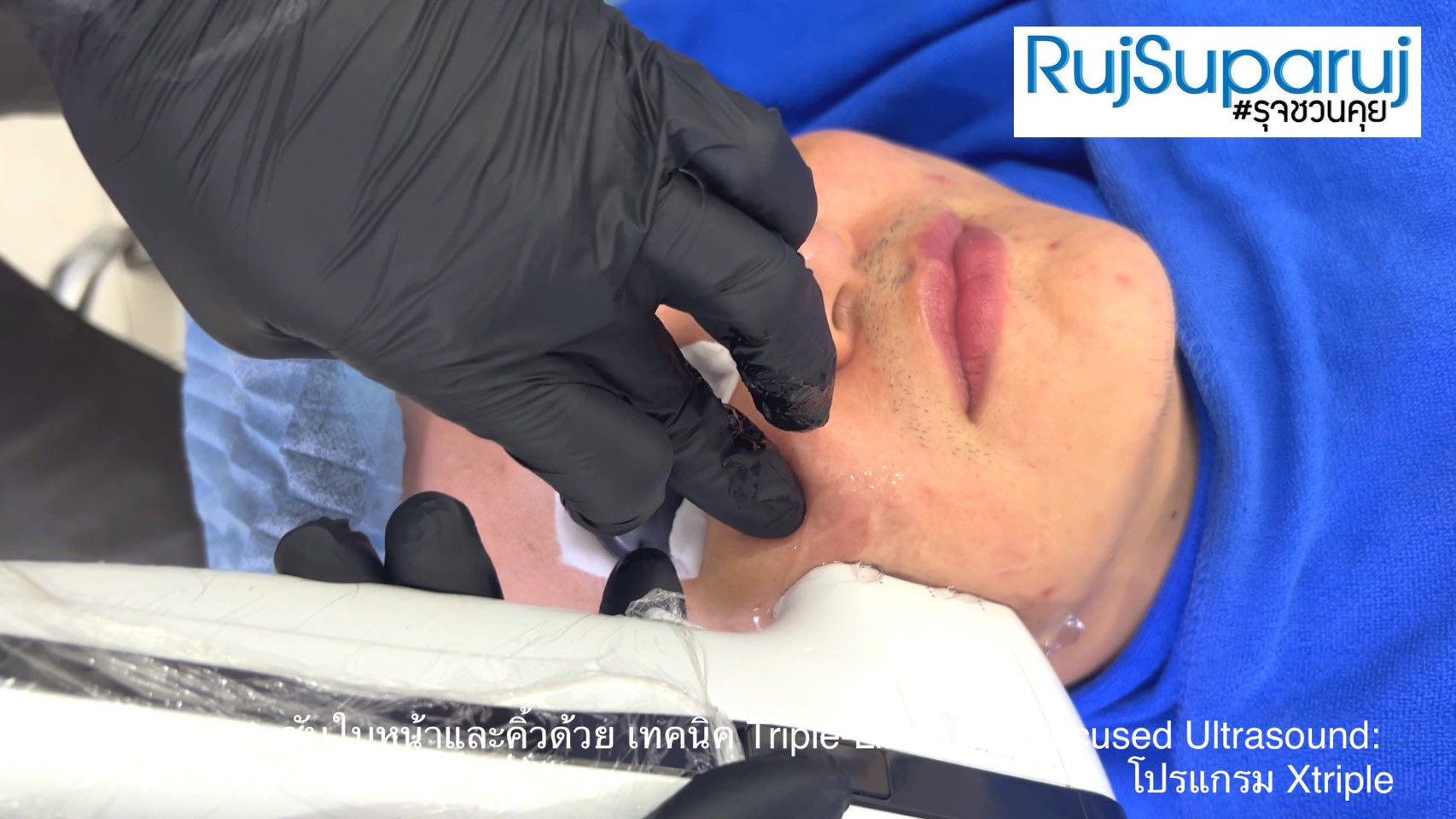 เทคนิคการยกกระชับใบหน้าและคิ้วด้วย Triple-Lined Multifocused Ultrasound: โปรแกรม X-Triple เทคนิคการยกกระชับใบหน้าและคิ้วด้วย Triple-Lined Multifocused Ultrasound: โปรแกรม X-Triple