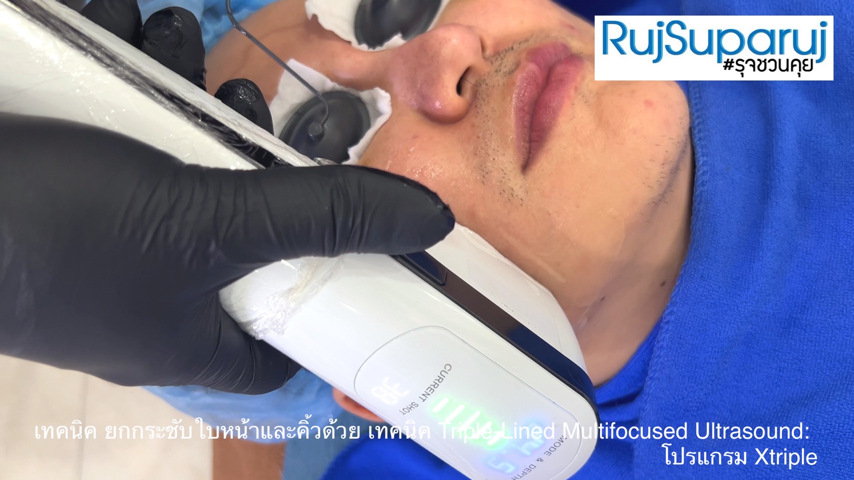 เทคนิคการยกกระชับใบหน้าและคิ้วด้วย Triple-Lined Multifocused Ultrasound: โปรแกรม X-Triple เทคนิคการยกกระชับใบหน้าและคิ้วด้วย Triple-Lined Multifocused Ultrasound: โปรแกรม X-Triple
