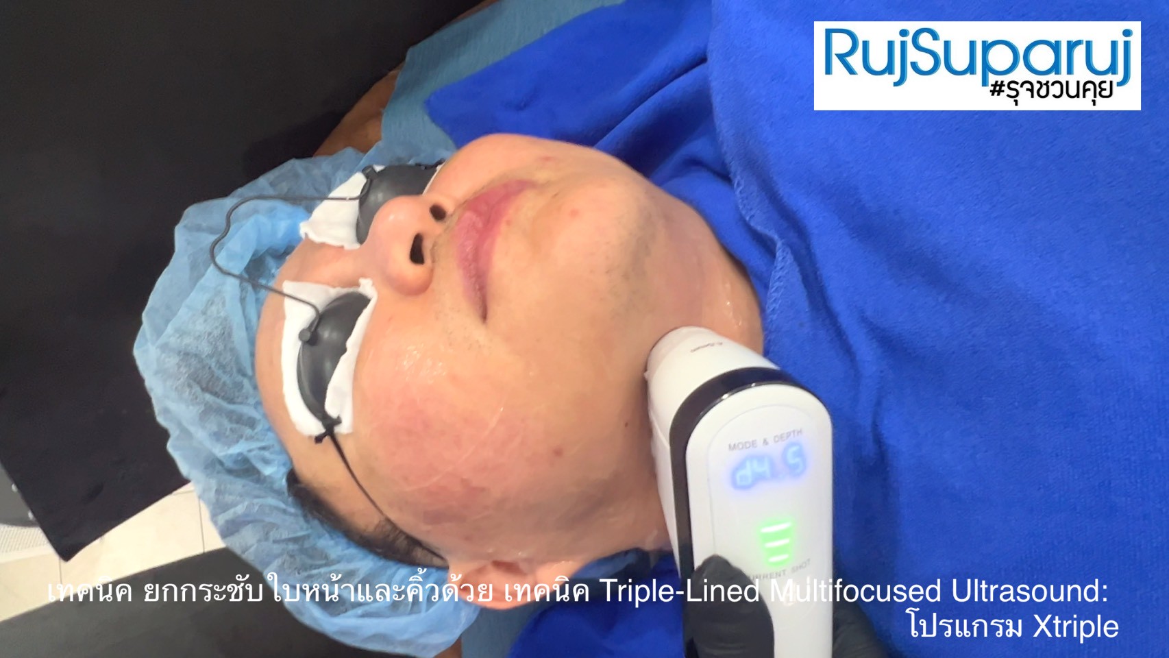 เทคนิคการยกกระชับใบหน้าและคิ้วด้วย Triple-Lined Multifocused Ultrasound: โปรแกรม X-Triple เทคนิคการยกกระชับใบหน้าและคิ้วด้วย Triple-Lined Multifocused Ultrasound: โปรแกรม X-Triple
