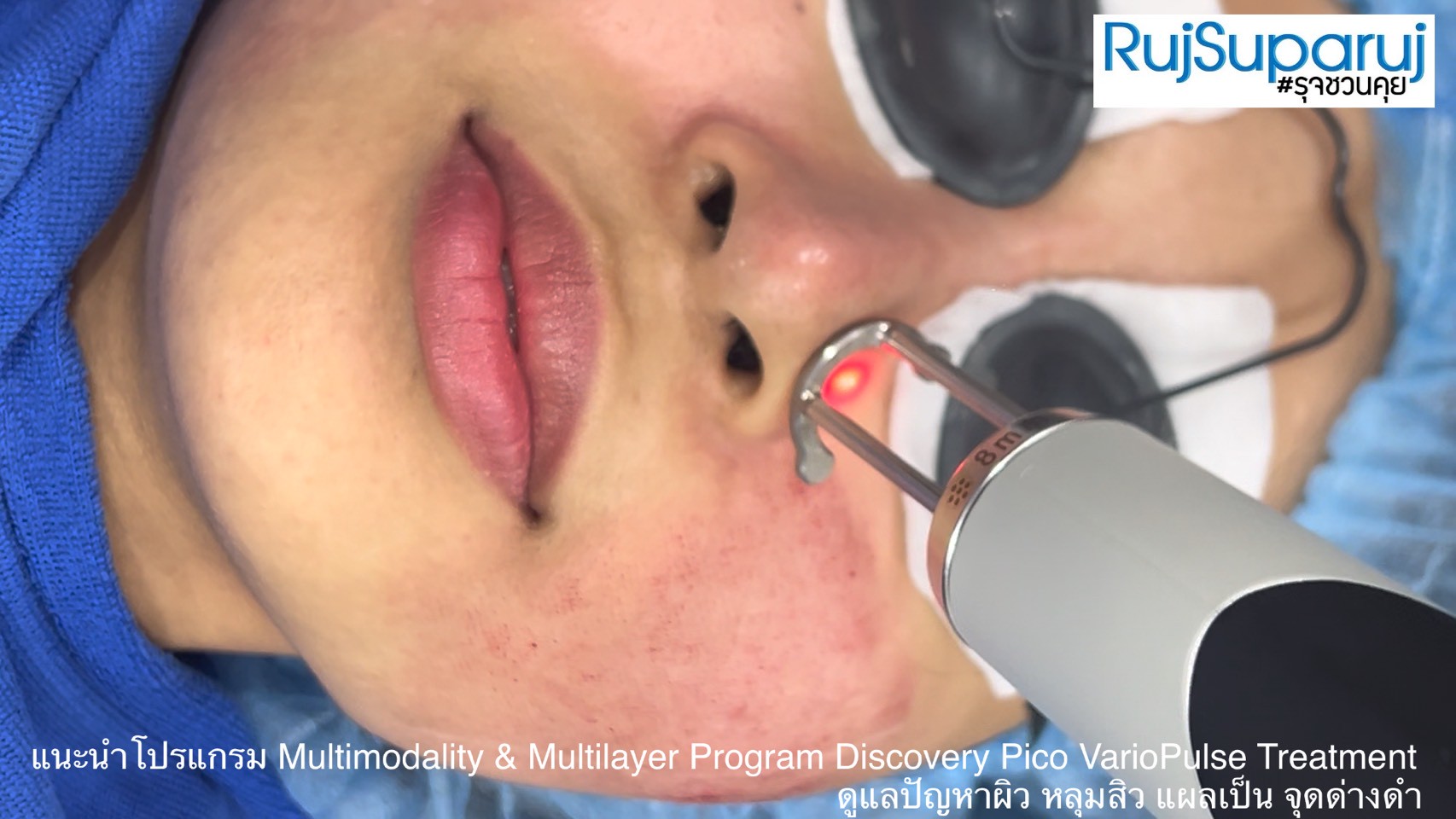 แนะนำโปรแกรม Multimodality & Multilayer Program Discovery Pico VarioPulse Treatment ดูแลปัญหาผิว หลุมสิว แผลเป็น จุดด่างดำ แนะนำโปรแกรม Multimodality & Multilayer Program Discovery Pico VarioPulse Treatment ดูแลปัญหาผิว หลุมสิว แผลเป็น จุดด่างดำ