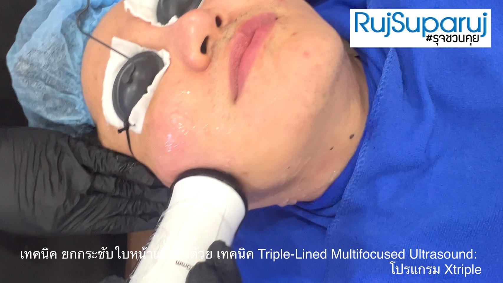เทคนิคการยกกระชับใบหน้าและคิ้วด้วย Triple-Lined Multifocused Ultrasound: โปรแกรม X-Triple เทคนิคการยกกระชับใบหน้าและคิ้วด้วย Triple-Lined Multifocused Ultrasound: โปรแกรม X-Triple