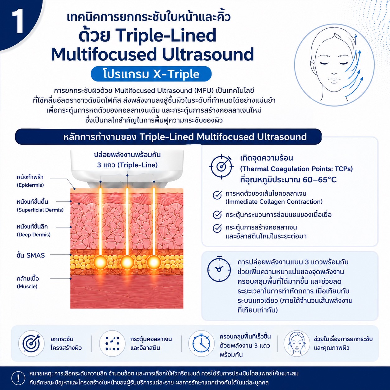 เทคนิคการยกกระชับใบหน้าและคิ้วด้วย Triple-Lined Multifocused Ultrasound: โปรแกรม X-Triple เทคนิคการยกกระชับใบหน้าและคิ้วด้วย Triple-Lined Multifocused Ultrasound: โปรแกรม X-Triple