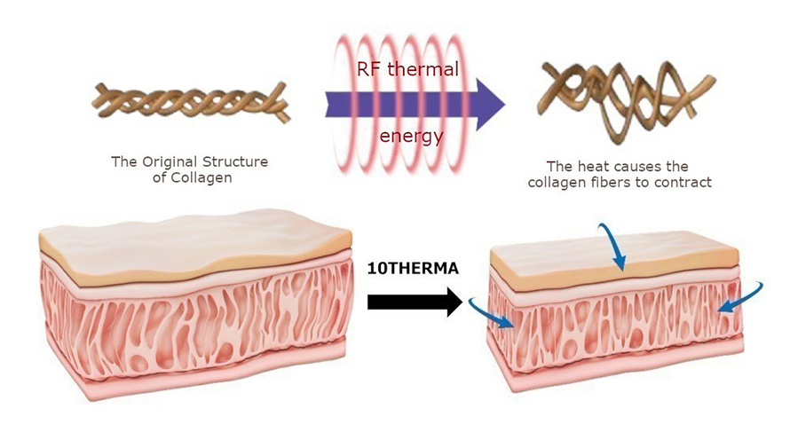 การดูแลความกระชับของผิวด้วย Program XTherma Monopolar RF การดูแลความกระชับของผิวด้วย Program XTherma Monopolar RF