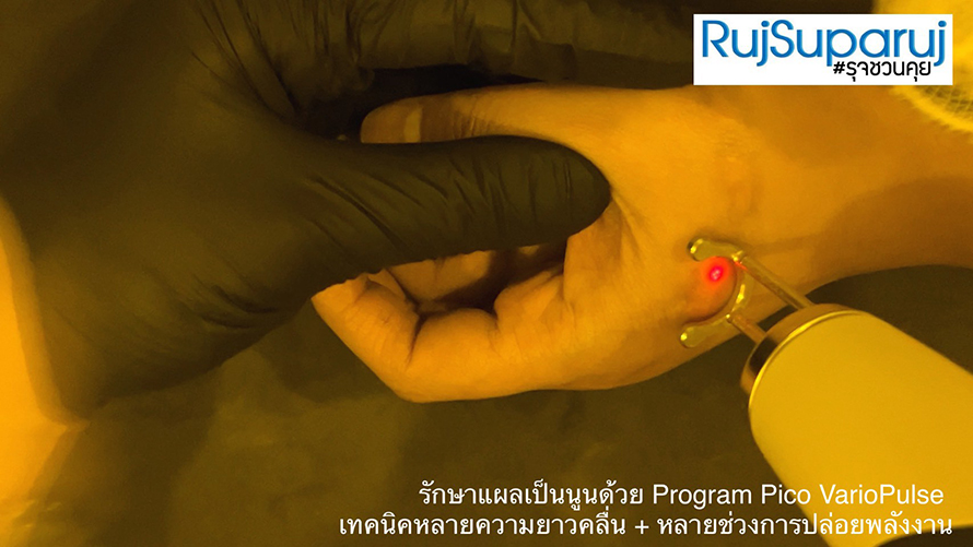 รักษาแผลเป็นนูนด้วย Program Pico VarioPulse เทคนิคหลายความยาวคลื่น + หลายช่วงการปล่อยพลังงาน รักษาแผลเป็นนูนด้วย Program Pico VarioPulse เทคนิคหลายความยาวคลื่น + หลายช่วงการปล่อยพลังงาน