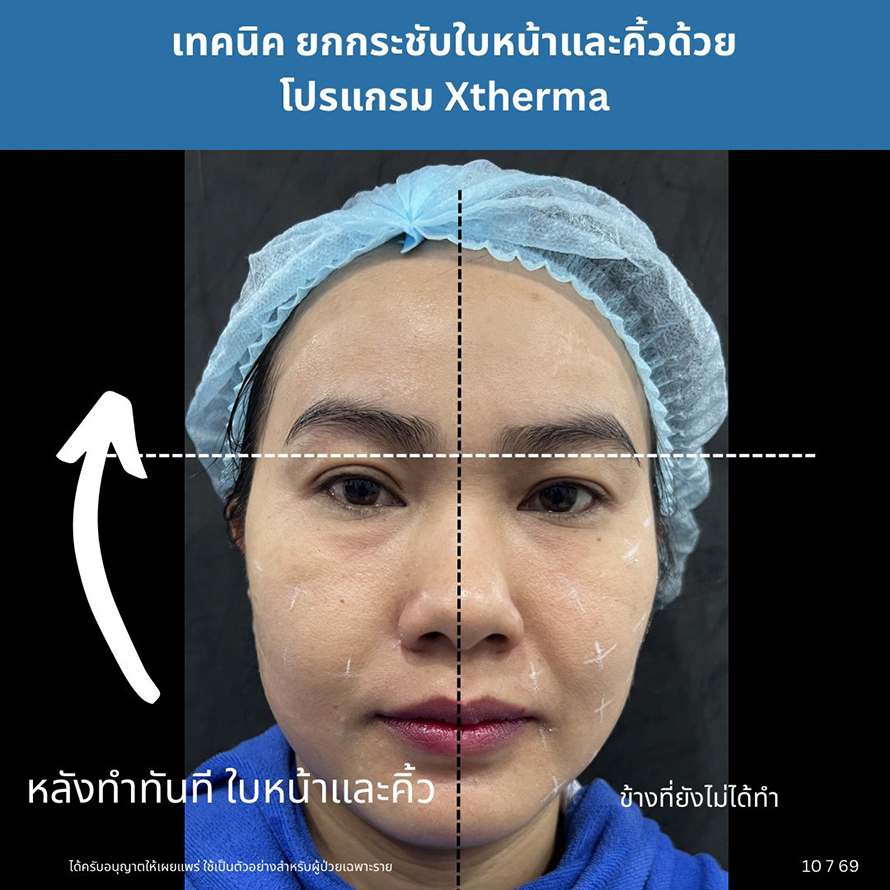 การดูแลความกระชับของผิวด้วย Program XTherma Monopolar RF การดูแลความกระชับของผิวด้วย Program XTherma Monopolar RF