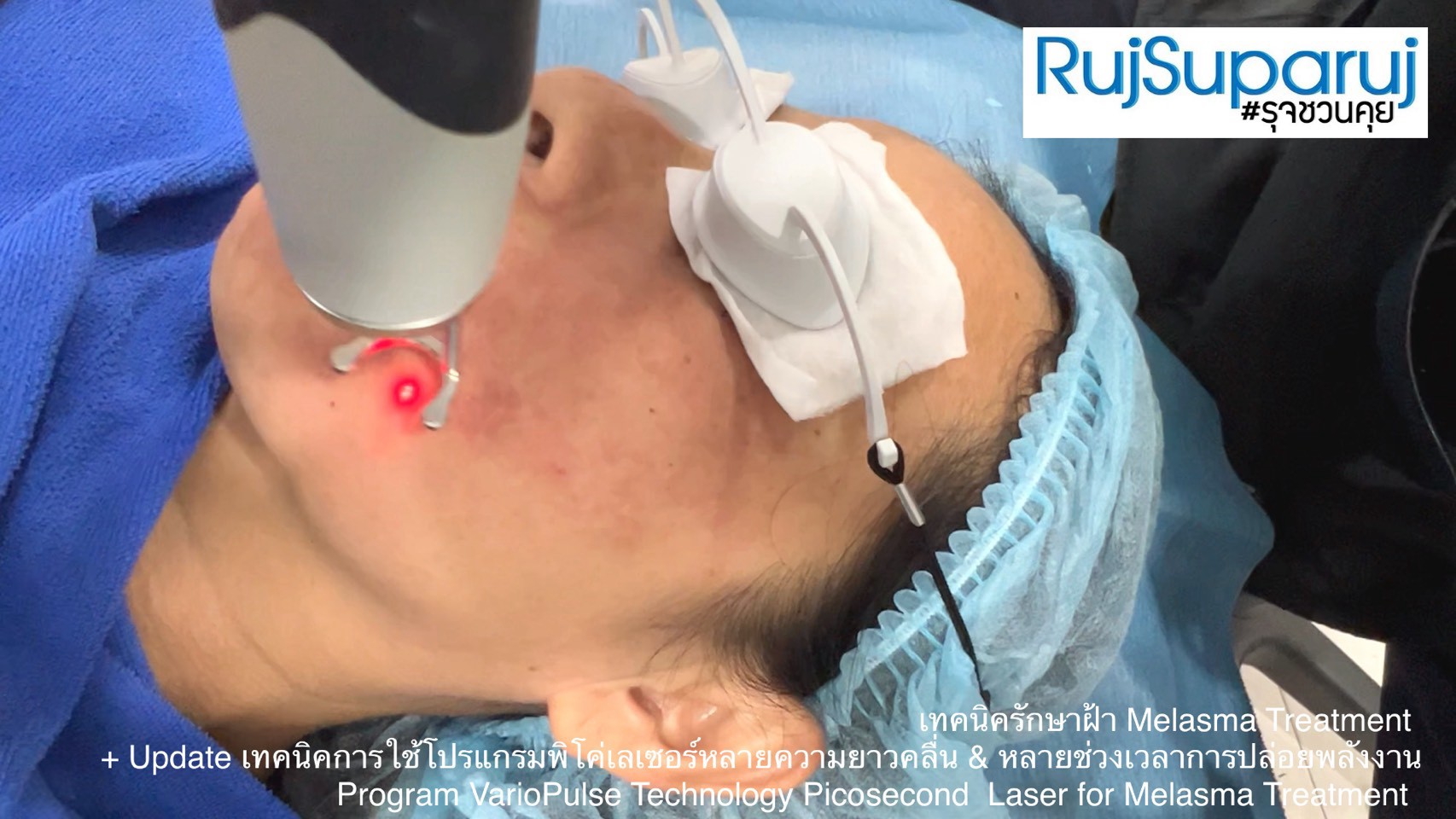 Update เทคนิคดูแลปัญหาฝ้า Melasma Treatment Update Update เทคนิคดูแลปัญหาฝ้า Melasma Treatment Update