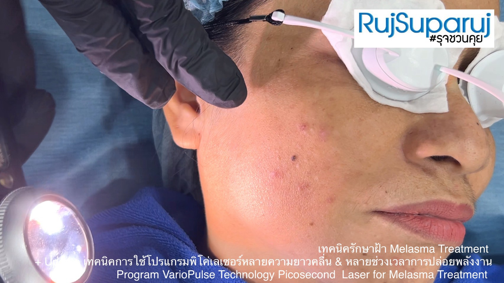 Update เทคนิคดูแลปัญหาฝ้า Melasma Treatment Update