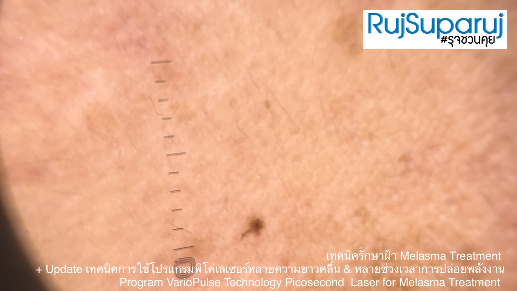 Update เทคนิคดูแลปัญหาฝ้า Melasma Treatment Update Update เทคนิคดูแลปัญหาฝ้า Melasma Treatment Update