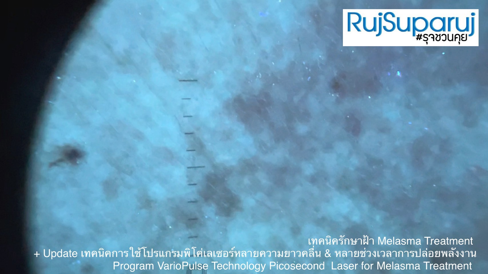 Update เทคนิคดูแลปัญหาฝ้า Melasma Treatment Update