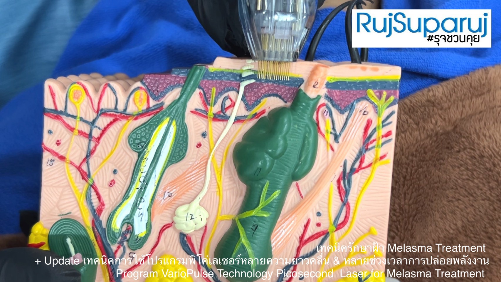 Update เทคนิคดูแลปัญหาฝ้า Melasma Treatment Update