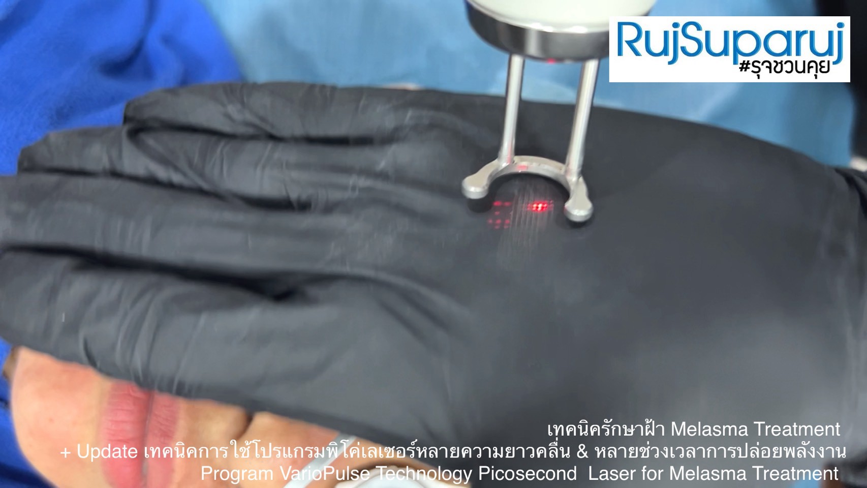 Update เทคนิคดูแลปัญหาฝ้า Melasma Treatment Update Update เทคนิคดูแลปัญหาฝ้า Melasma Treatment Update