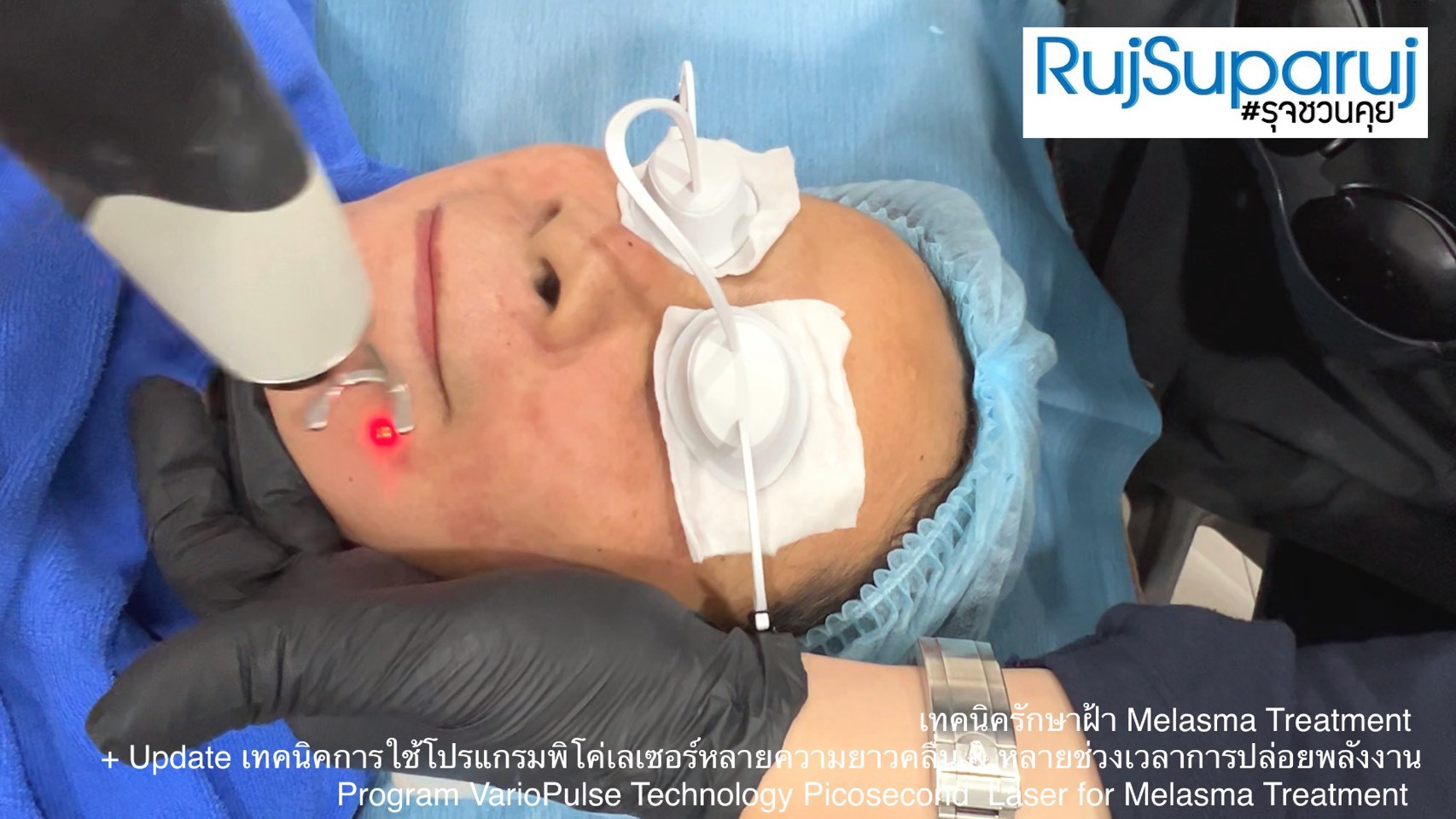 Update เทคนิคดูแลปัญหาฝ้า Melasma Treatment Update Update เทคนิคดูแลปัญหาฝ้า Melasma Treatment Update