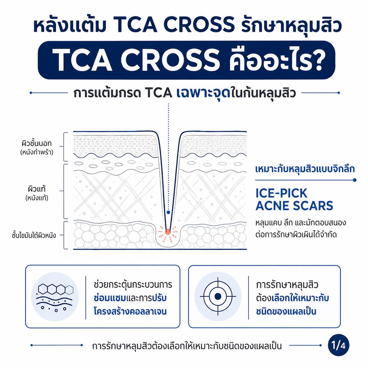 แต้ม TCA CROSS รักษาหลุมสิว รอยแดงและรอยดำ บอกอะไรเราได้บ้างครับ?