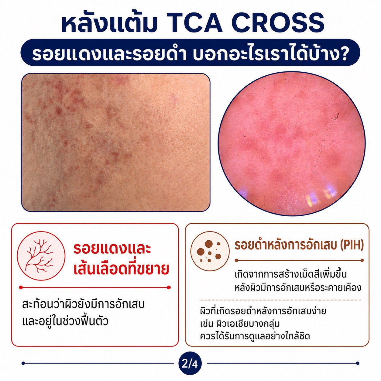 แต้ม TCA CROSS รักษาหลุมสิว รอยแดงและรอยดำ บอกอะไรเราได้บ้างครับ?