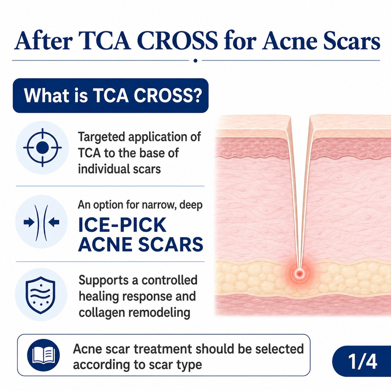 Ice-pick acne scars are narrow, deep scars that may respond only modestly to superficial treatments. One option a physician may consider is TCA CROSS—the focal application of trichloroacetic acid (TCA) to the base of individual scars. Ice-pick acne scars are narrow, deep scars that may respond only modestly to superficial treatments. One option a physician may consider is TCA CROSS—the focal application of trichloroacetic acid (TCA) to the base of individual scars.