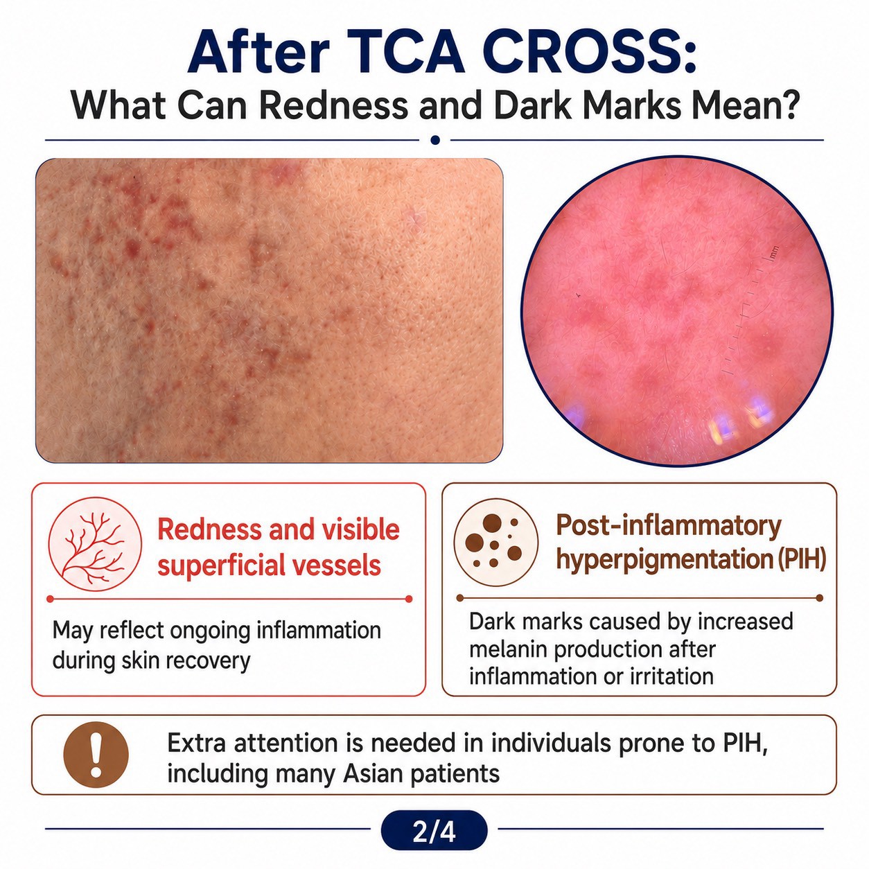  Ice-pick acne scars are narrow, deep scars that may respond only modestly to superficial treatments. One option a physician may consider is TCA CROSS—the focal application of trichloroacetic acid (TCA) to the base of individual scars.