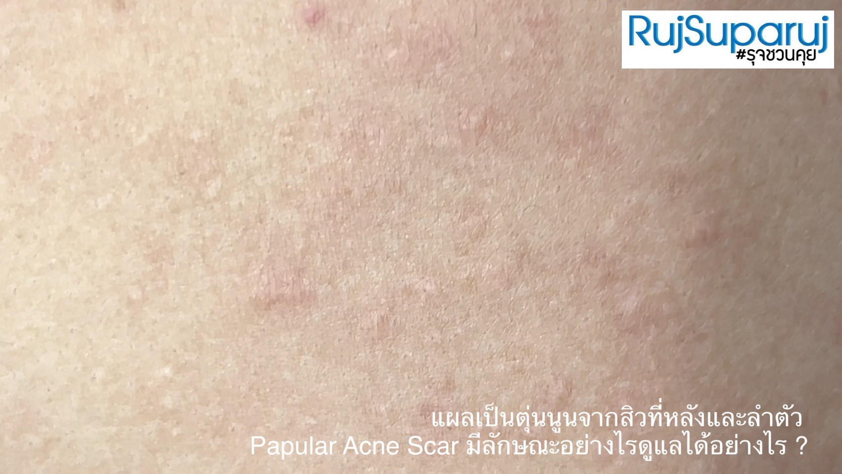 แผลเป็นตุ่นนูนจากสิวที่หลังและลำตัว Papular Acne Scar มีลักษณะอย่างไรดูแลได้อย่างไร ?