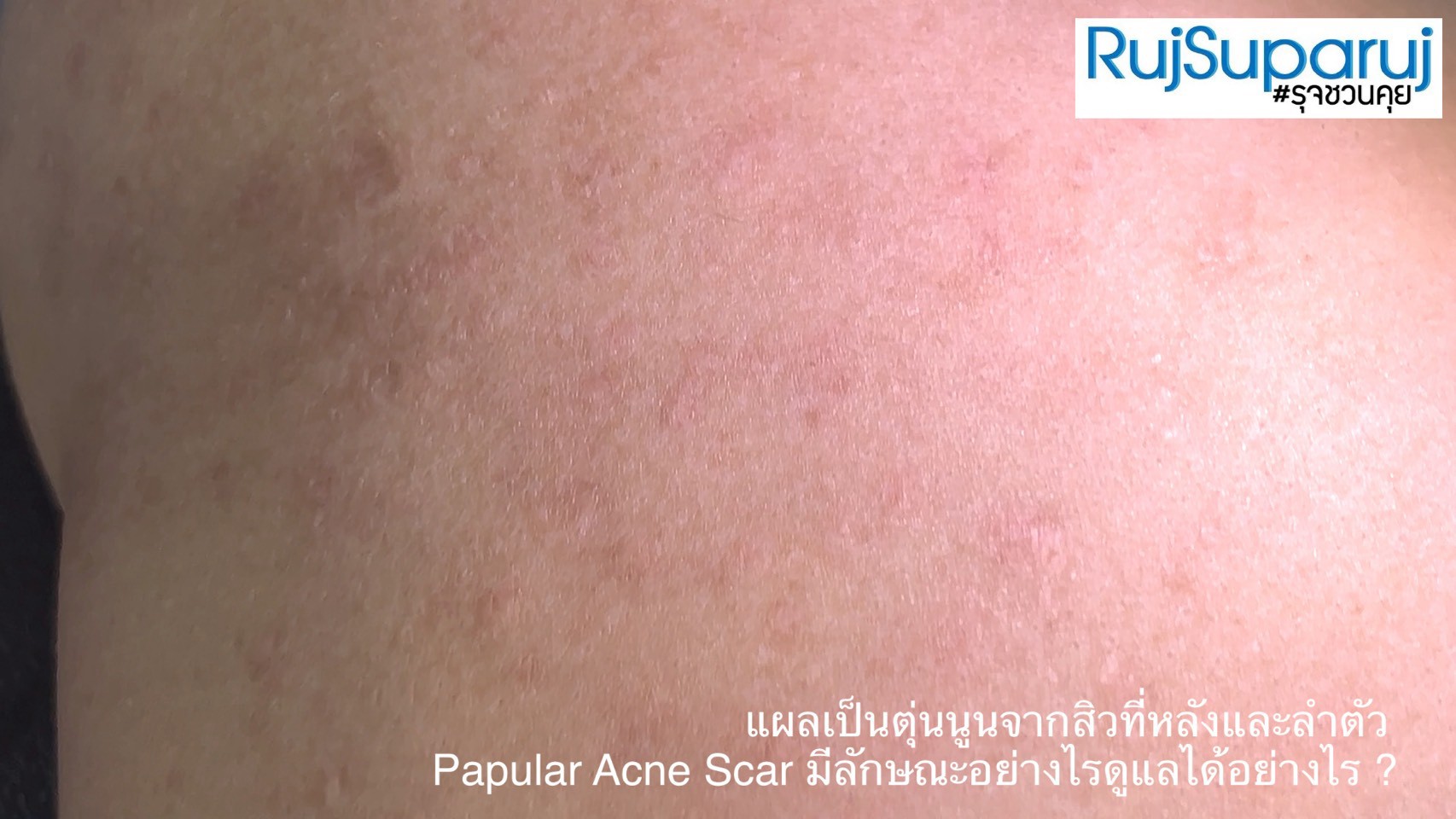 แผลเป็นตุ่นนูนจากสิวที่หลังและลำตัว Papular Acne Scar มีลักษณะอย่างไรดูแลได้อย่างไร ? แผลเป็นตุ่นนูนจากสิวที่หลังและลำตัว Papular Acne Scar มีลักษณะอย่างไรดูแลได้อย่างไร ?