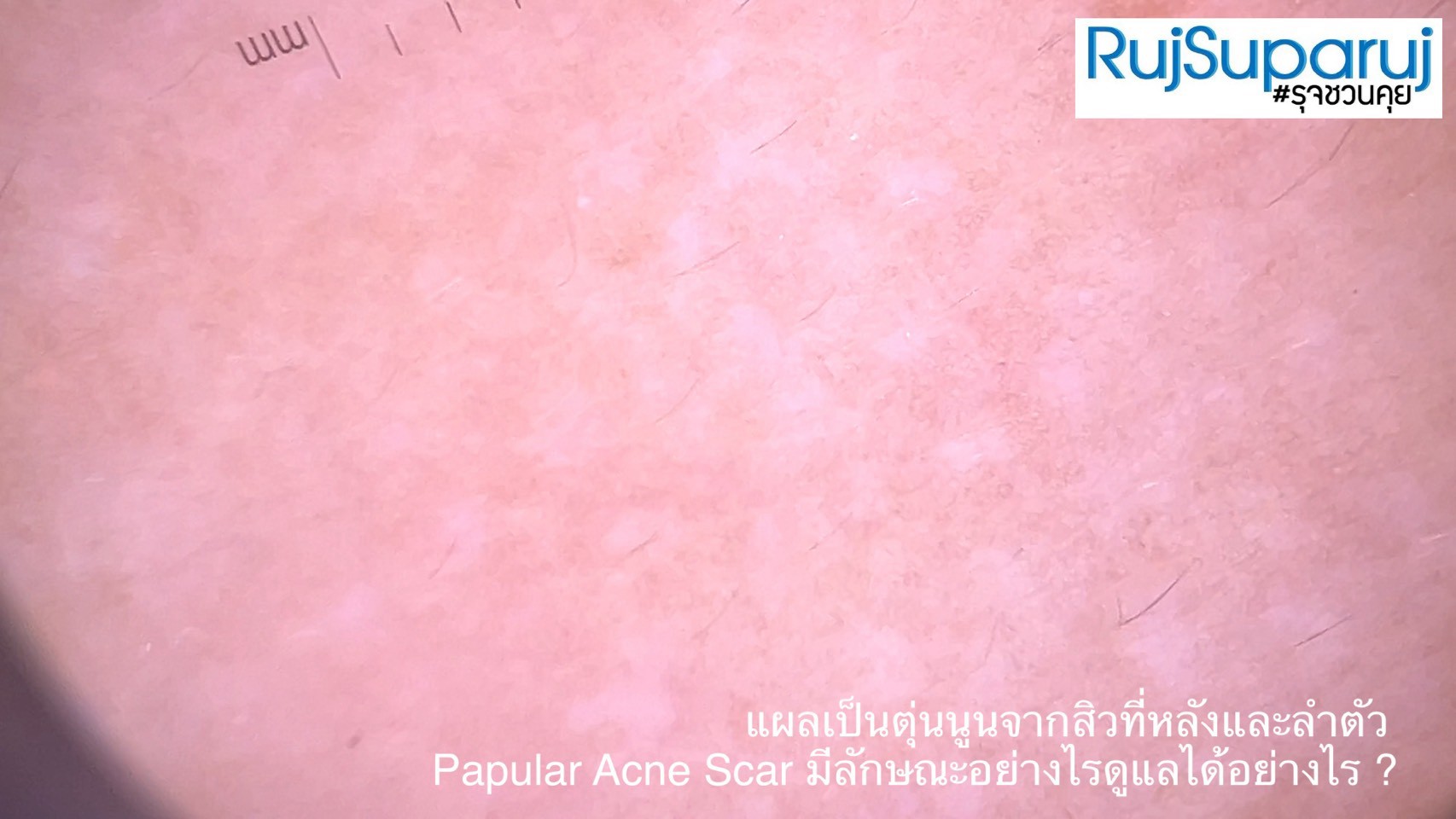แผลเป็นตุ่นนูนจากสิวที่หลังและลำตัว Papular Acne Scar มีลักษณะอย่างไรดูแลได้อย่างไร ?