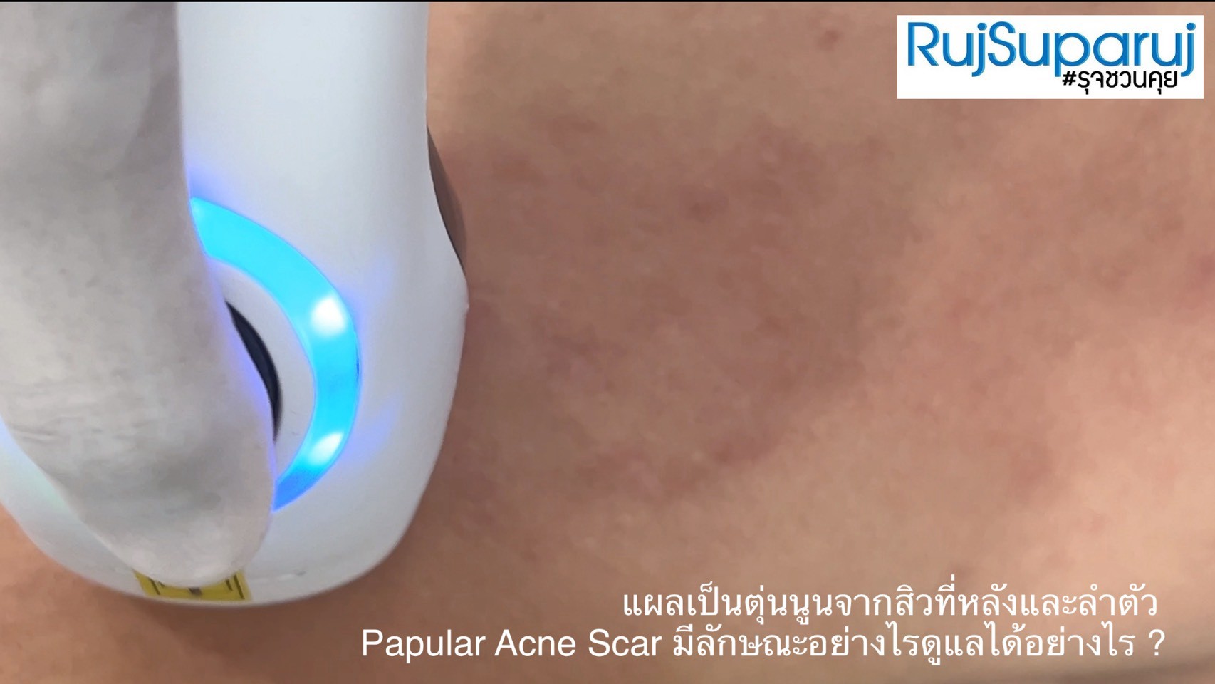 แผลเป็นตุ่นนูนจากสิวที่หลังและลำตัว Papular Acne Scar มีลักษณะอย่างไรดูแลได้อย่างไร ?