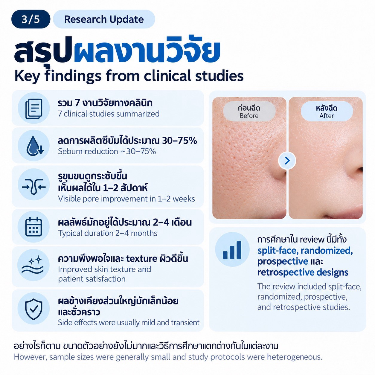 งานวิจัยทบทวน: การฉีด Botulinum Toxin Type A ในชั้นผิวเพื่อช่วยลดความมันและรูขุมขนกว้าง
