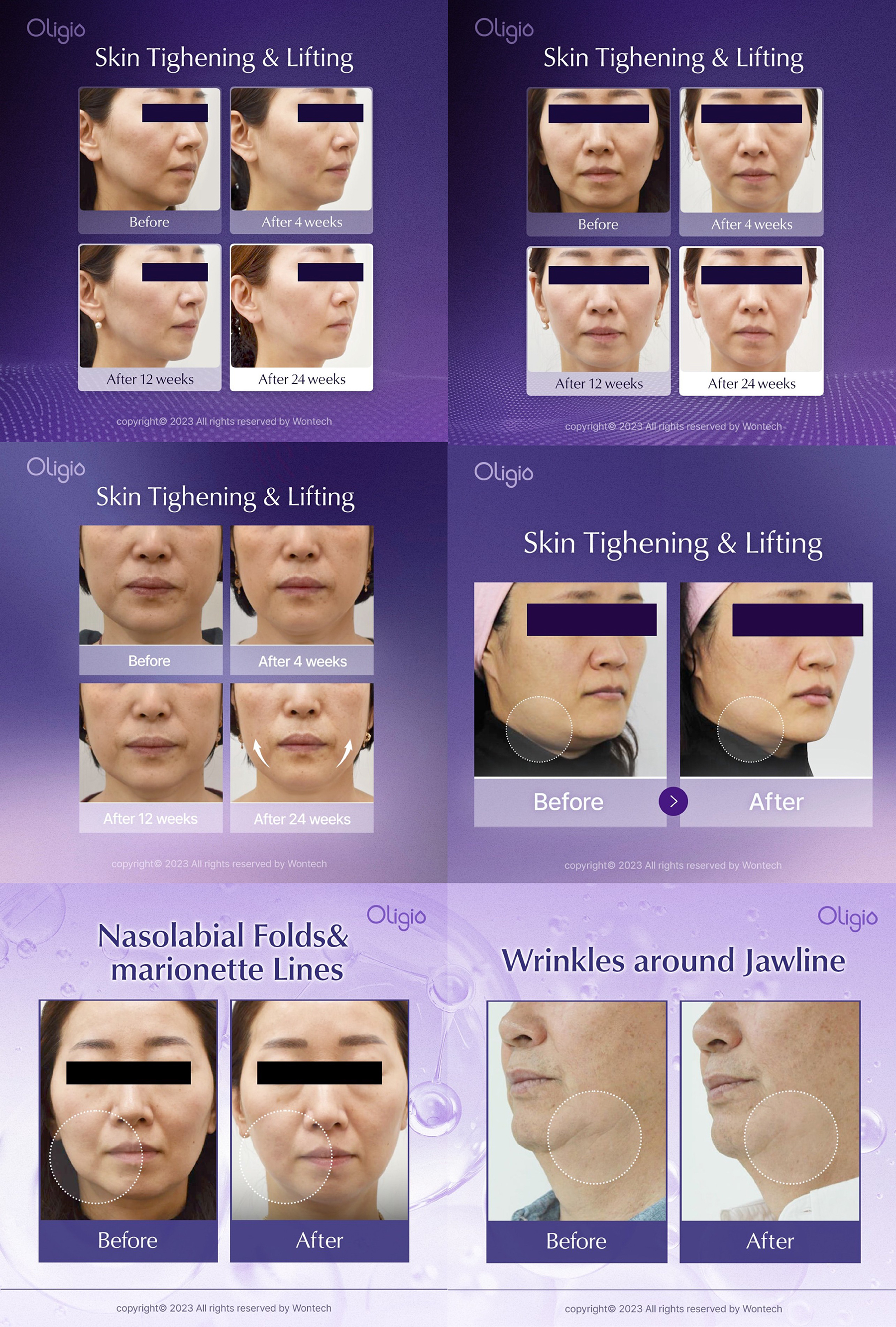 ผลลัพธ์หลังการรักษาด้วย โปรแกรม Oligio เป็นอย่างไร? ผลลัพธ์หลังการรักษาด้วย โปรแกรม Oligio เป็นอย่างไร?