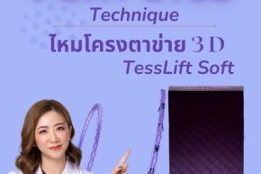 Foxy eyes แก้ไขหนังตาตก คิ้วตก ไม่ต้องผ่าตัด ด้วยไหมโครงตาข่าย Tesslift soft