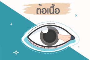 " ต้อเนื้อ "