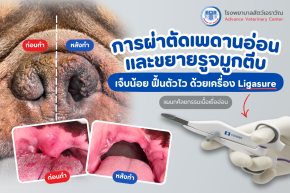 การผ่าตัดเพดานอ่อนและขยายรูจมูกตีบ เจ็บน้อย ฟื้นตัวไว ด้วยเครื่อง Ligasure