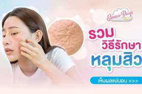 รวมวิธีรักษาหลุมสิว สิวหายแต่ทิ้งหลุมไว้ อยากหายต้องทำไงดี