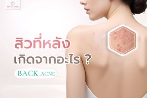 สิวหลัง ( Back Acne )