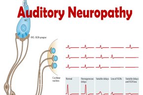 ความผิดปกติของการได้ยินจากความเสื่อมของระบบประสาท (AUDITORY NEUROPATHY)