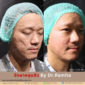 รักษาหลุมสิว ฟิลเลอร์หลุมสิว ศัลยกรรมหลุมสิว เติมเต็มหลุมสิว ผ่าตัดหลุมสิว real acne scar synergy ฟื้นฟูหลุมสิว หลุมสิวเกาหลี