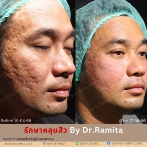 รักษาหลุมสิว ฟิลเลอร์หลุมสิว ศัลยกรรมหลุมสิว เติมเต็มหลุมสิว ผ่าตัดหลุมสิว real acne scar synergy ฟื้นฟูหลุมสิว หลุมสิวเกาหลี