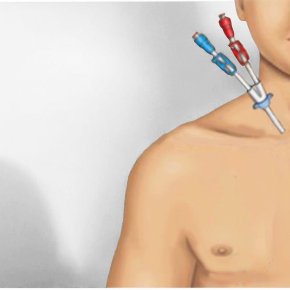 สายฟอกไตชั่วคราว(DLC) คืออะไร? 